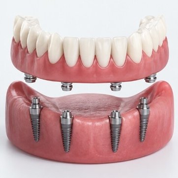 Implant-supported overdenture showing four dental implants in the lower jaw